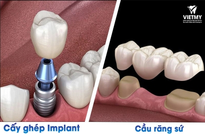 Cầu răng hay cấy ghép implant: Phương pháp trồng răng nào là tối ưu nhất?